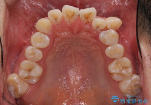 前歯の叢生を解消　ワイヤー装置での抜歯矯正の治療前