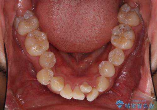 前歯の叢生を解消 ワイヤー装置での抜歯矯正の治療前