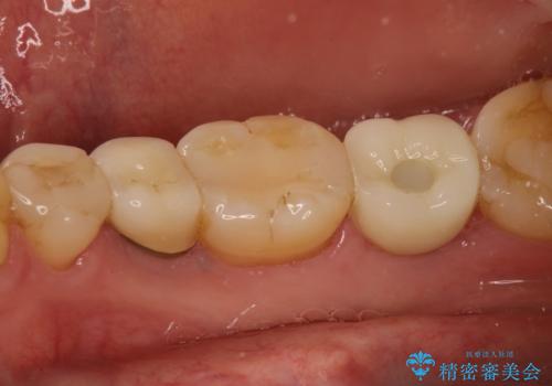 右下の奥歯を抜歯　インプラント治療による咬合回復の治療後