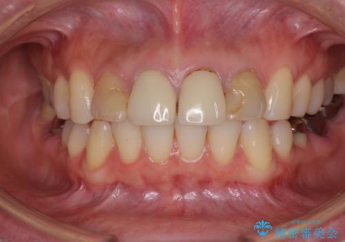 変色した歯をセラミックできれいにの治療前