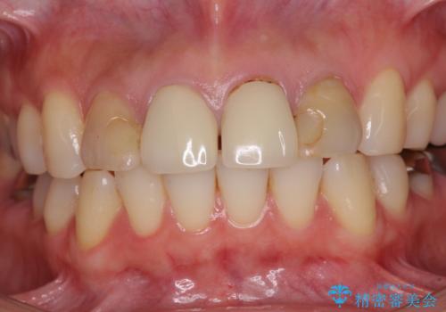 変色した歯をセラミックできれいにの治療前