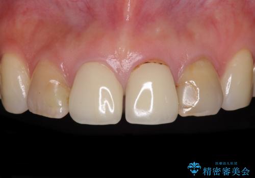 変色した歯をセラミックできれいにの症例 治療前