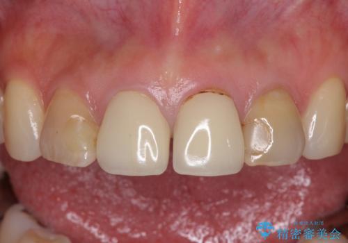 変色した歯をセラミックできれいにの治療前
