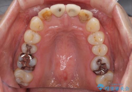 変色した歯をセラミックできれいにの治療前