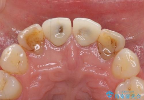 変色した歯をセラミックできれいにの治療前
