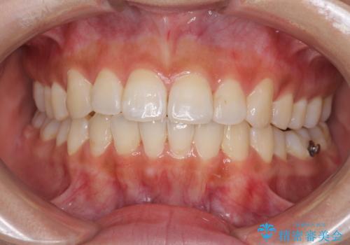 前歯のデコボコが気になる インビザラインによる矯正治療の治療中