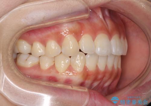 前歯のデコボコが気になる インビザラインによる矯正治療の治療中