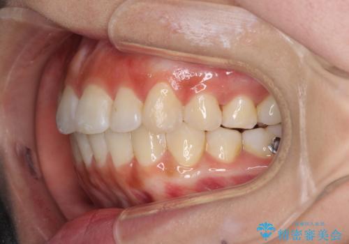 前歯のデコボコが気になる インビザラインによる矯正治療の治療中