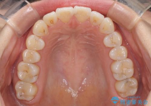 前歯のデコボコが気になる インビザラインによる矯正治療の治療中