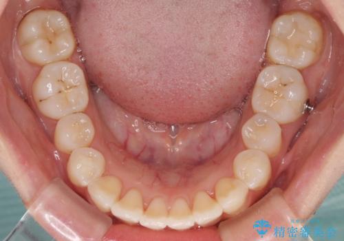 前歯のデコボコが気になる インビザラインによる矯正治療の治療中