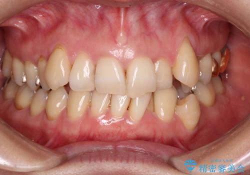 【非抜歯矯正】インビザラインによる矯正の治療前