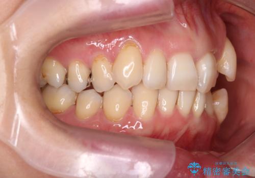 【非抜歯矯正】インビザラインによる矯正の治療前