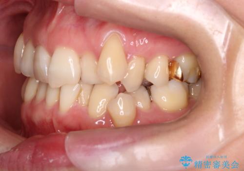 【非抜歯矯正】インビザラインによる矯正の治療前