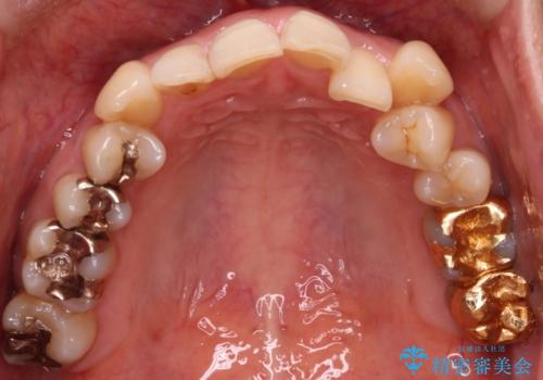 【非抜歯矯正】インビザラインによる矯正の治療前