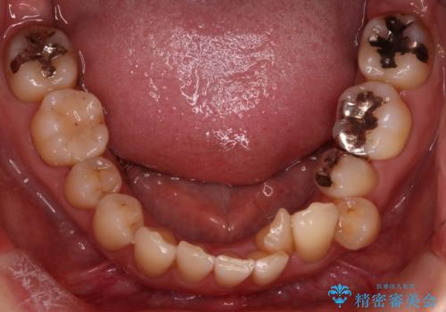 【非抜歯矯正】インビザラインによる矯正の治療前