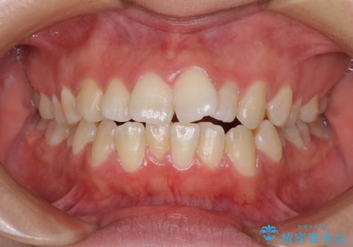 【モニター】オープンバイトをインビザラインで矯正治療の症例 治療前