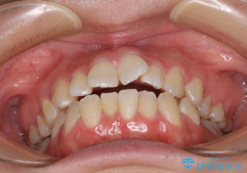 【モニター】オープンバイトをインビザラインで矯正治療の治療前