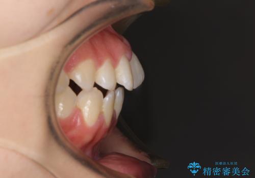 【モニター】オープンバイトをインビザラインで矯正治療の治療前
