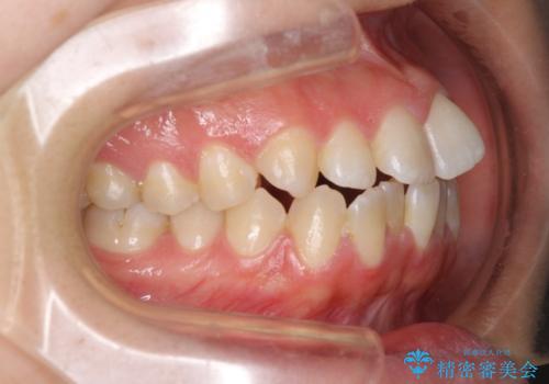 【モニター】オープンバイトをインビザラインで矯正治療の治療前