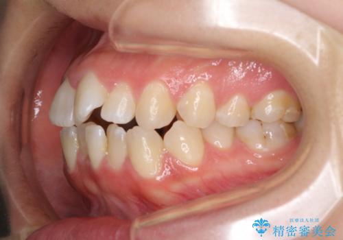 【モニター】オープンバイトをインビザラインで矯正治療の治療前