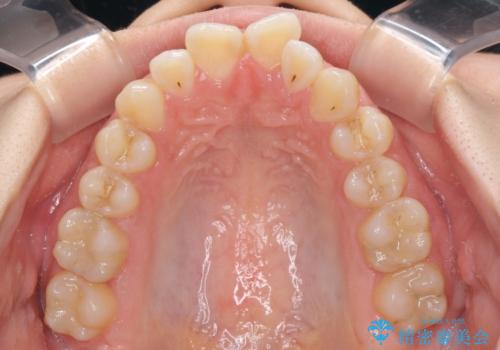 【モニター】オープンバイトをインビザラインで矯正治療の治療前