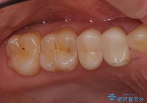 他院の根の治療で一向に治らない、さらに歯根を切ってもらったが良くならないの治療後