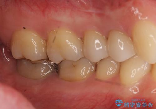 他院の根の治療で一向に治らない、さらに歯根を切ってもらったが良くならないの治療後