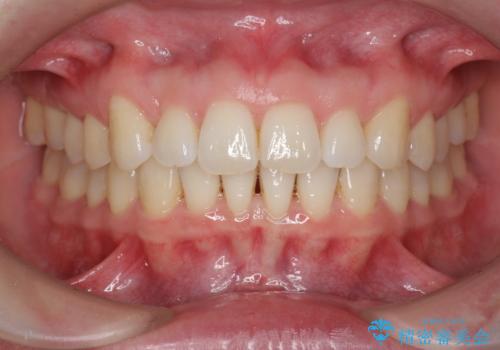 インビザライン で治す  出っ歯の治療の治療後