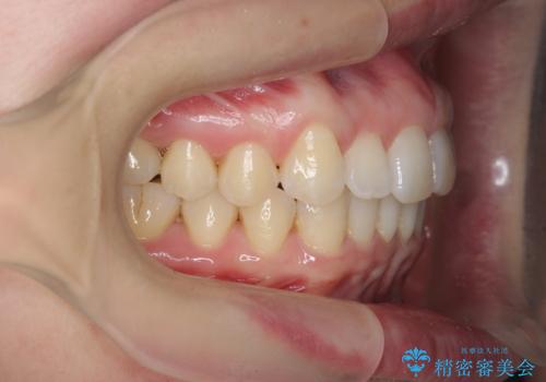 インビザライン で治す  出っ歯の治療の治療後