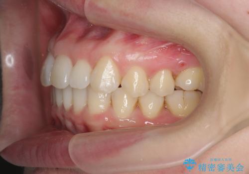 インビザライン で治す  出っ歯の治療の治療後
