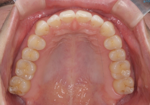 インビザライン で治す  出っ歯の治療の治療後