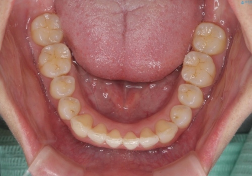 インビザライン で治す  出っ歯の治療の治療後
