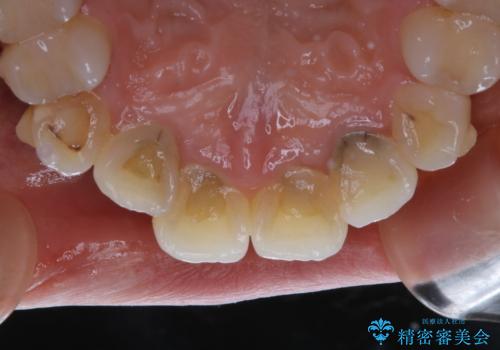 インビザライン矯正治療中のPMTCの治療前