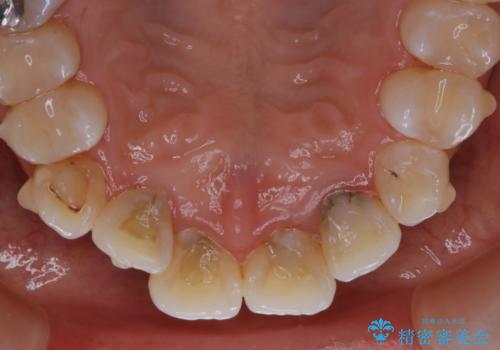 インビザライン矯正治療中のPMTCの治療後