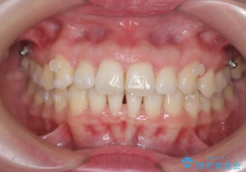 インビザライン で治す  出っ歯の治療の治療中