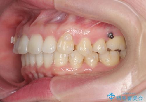 インビザライン で治す  出っ歯の治療の治療中