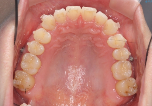 インビザライン で治す  出っ歯の治療の治療中