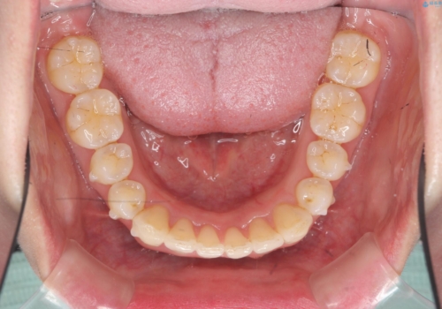 インビザライン で治す  出っ歯の治療の治療中
