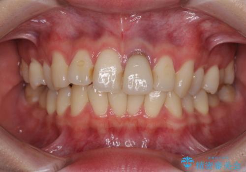 境目が見えている前歯のクラウンをオールセラミッククラウンにの治療前