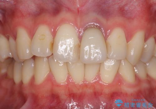 境目が見えている前歯のクラウンをオールセラミッククラウンにの治療前
