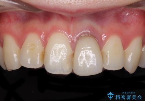 境目が見えている前歯のクラウンをオールセラミッククラウンにの治療前