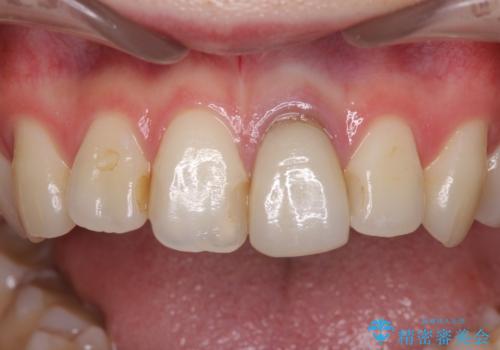 境目が見えている前歯のクラウンをオールセラミッククラウンにの治療前