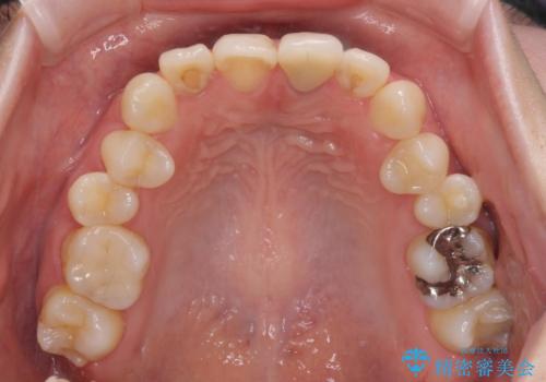 境目が見えている前歯のクラウンをオールセラミッククラウンにの治療前