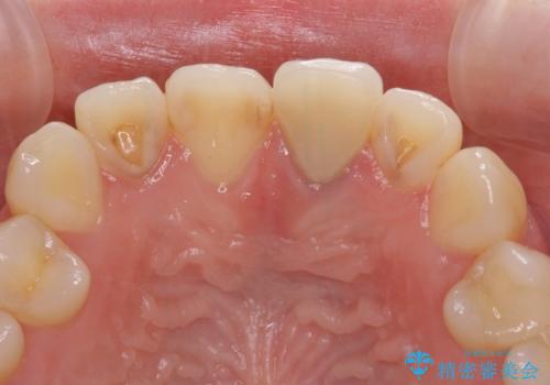 境目が見えている前歯のクラウンをオールセラミッククラウンにの治療前