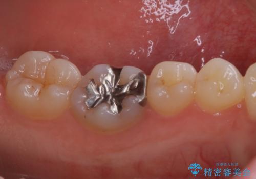 適合のよいセラミックで自分の歯となじむ自然な仕上がりにの治療前