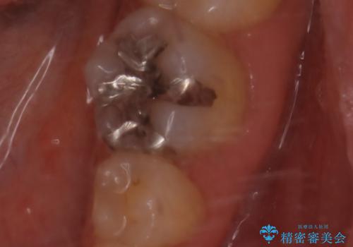 適合のよいセラミックで自分の歯となじむ自然な仕上がりにの治療前