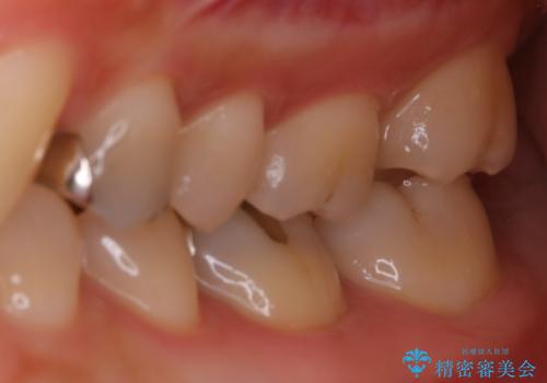 適合のよいセラミックで自分の歯となじむ自然な仕上がりにの治療前