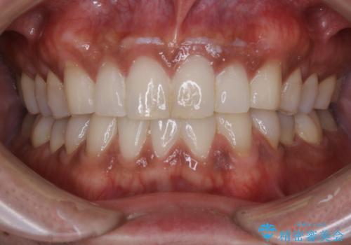 PMTCで歯周病の予防の治療前