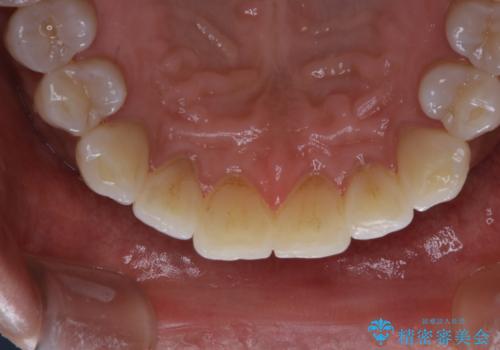 PMTCで歯周病の予防の治療前