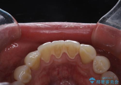 PMTCで歯周病の予防の治療前
